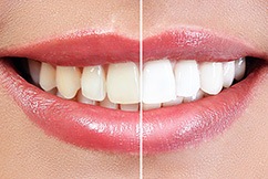 Up-close view of stained and brighter teeth