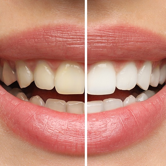 a before-and-after picture demonstrating teeth whitening results