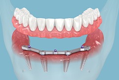 Digital image of an implant denture