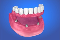Dentures on implants