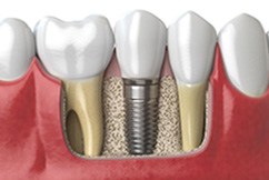 Single dental implant between natural teeth