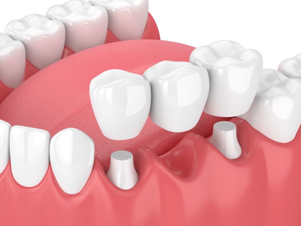 A computer-generated image of a dental bridge